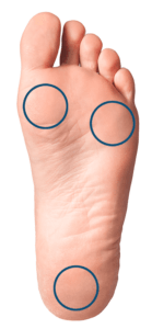 Foot diagram with the metatarsals and heel circled.