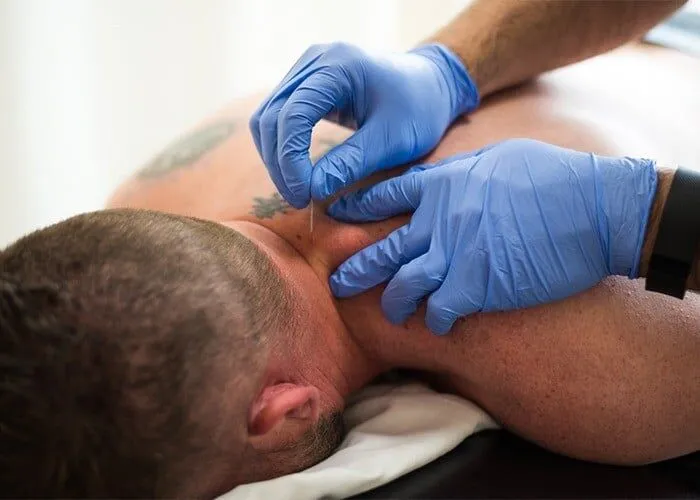 Dry-Needling-Treatment Athlete running in place