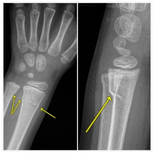 Image of an x-ray showing a wrist with a buckle fracture.