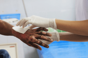 Treating patient with hand burns