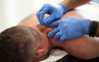 Feature image of a man receiving dry needling treatment in his neck.