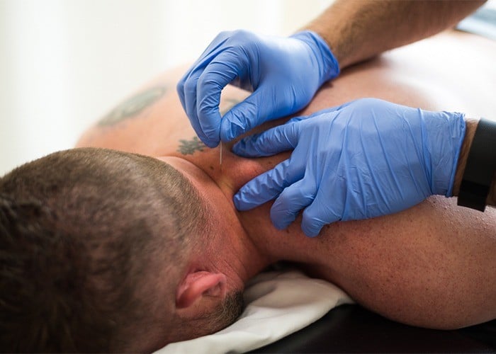 Man receives dry needling treatment