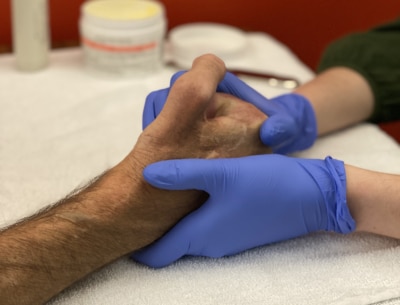 A hand therapist wearing gloves as they treat pain caused by inflammation and swelling on a patient's hand.
