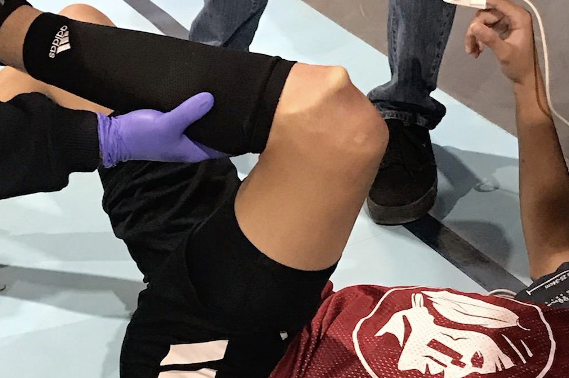 A popped knee on a young athlete.