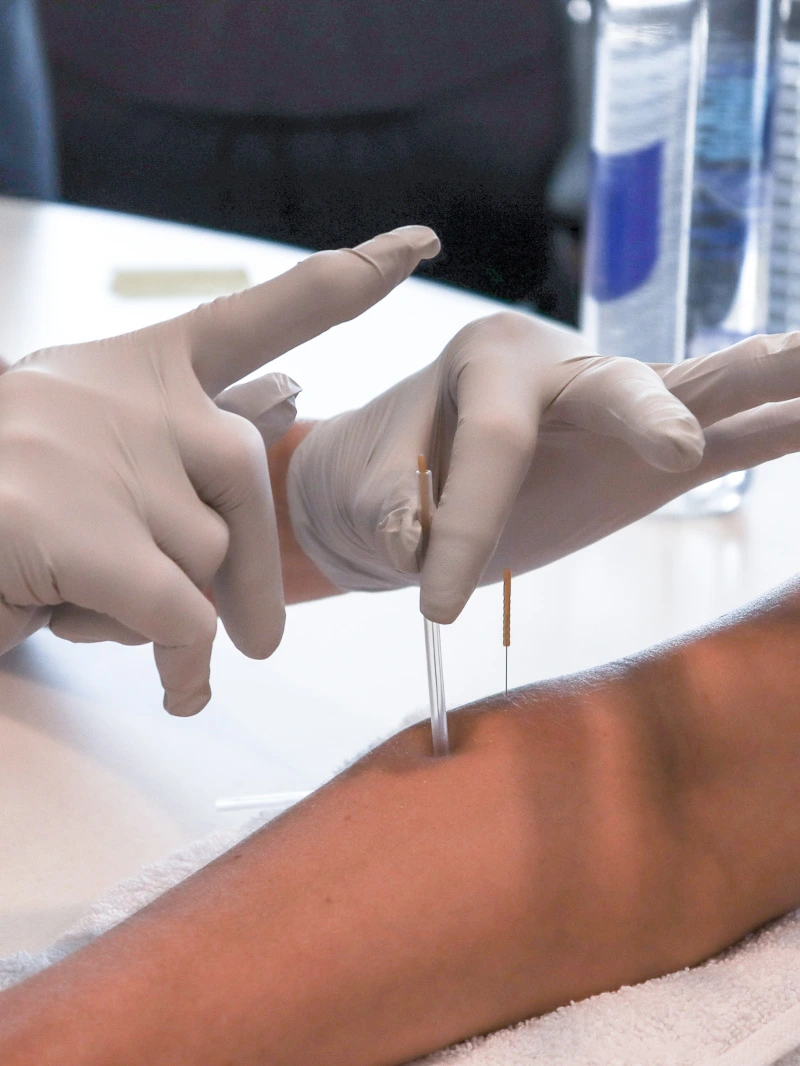 Image of a therapist dry needling a patient's arm.