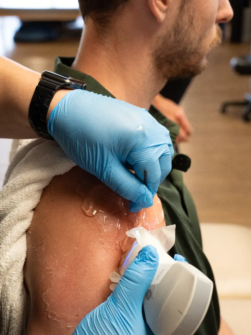 Image of a man having ultrasound dry needling done on his shoulder.